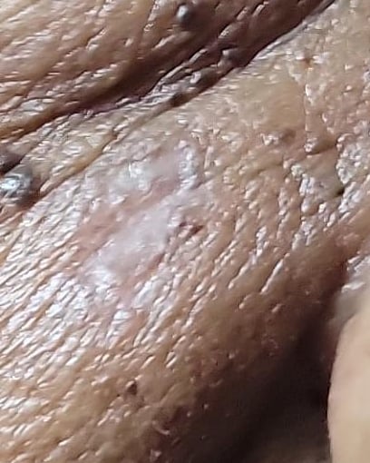 Antes y después de queratosis seborreica, tratada por la Dra. Orquídea Mejía